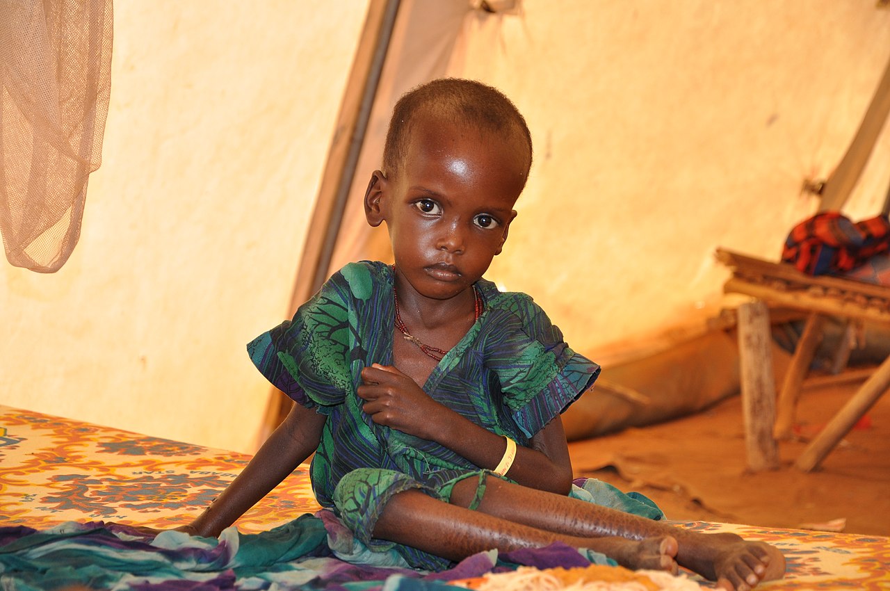desnutricao-afecta-40-das-criancas-e-ameaca-o-futuro-capital-humano-de-angola